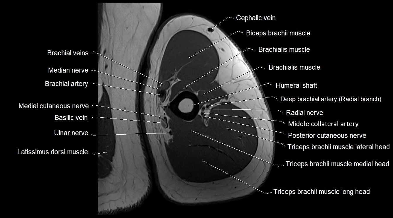 Upper arm( humerus) cross section anatomy MRI 3T axial image 35.webp